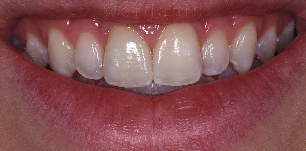 After image